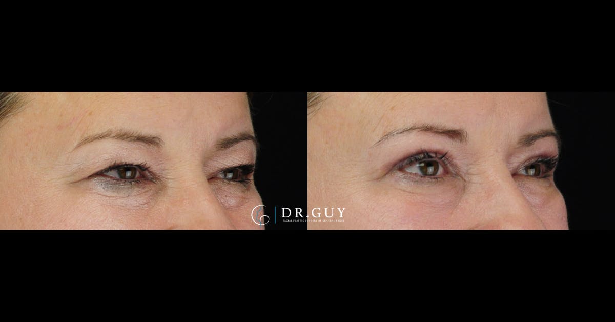 Upper Blepharoplasty Before & After Gallery - Patient 306213 - Image 3