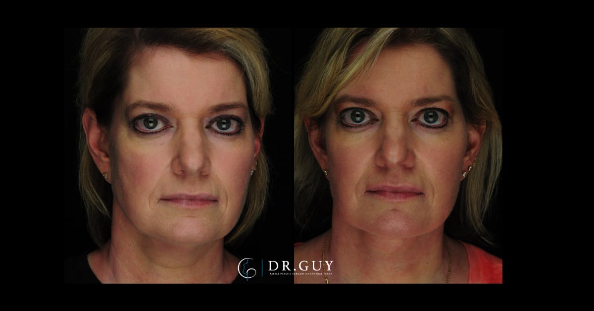 Mini Facelift Before & After Gallery - Patient 246058 - Image 4