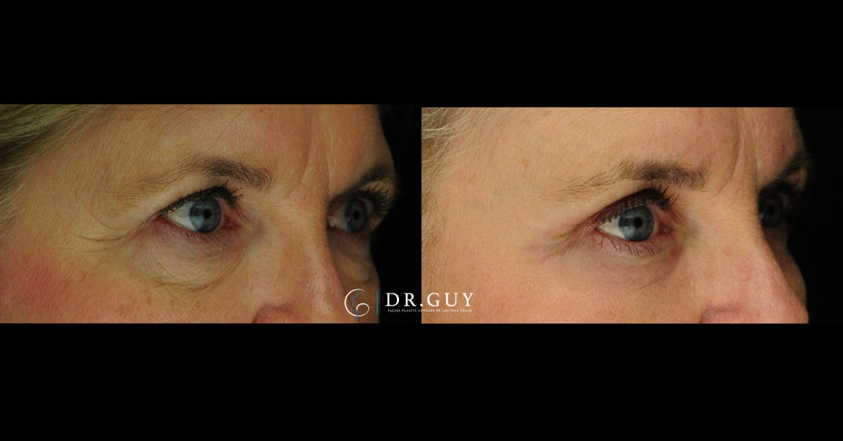 Browlift Before & After Gallery - Patient 781891 - Image 2