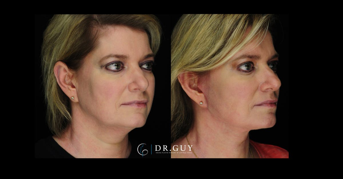Mini Facelift Before & After Gallery - Patient 246058 - Image 5
