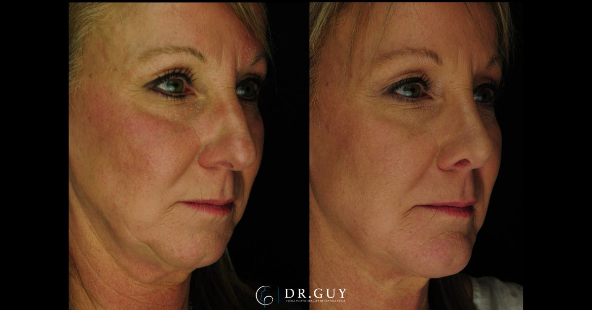 Chin Before & After Gallery - Patient 314905 - Image 4