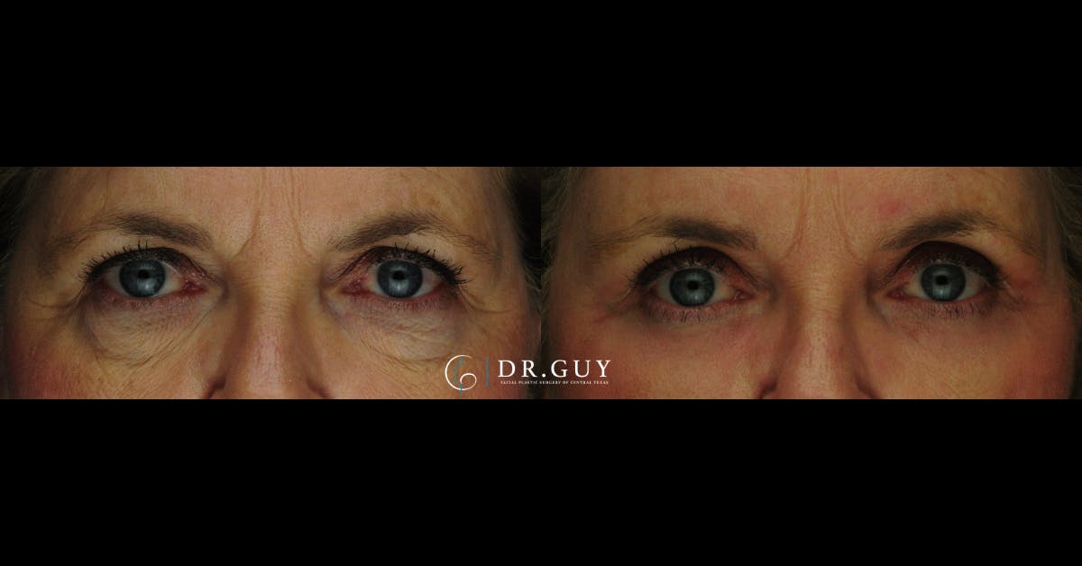 Browlift Before & After Gallery - Patient 781891 - Image 3