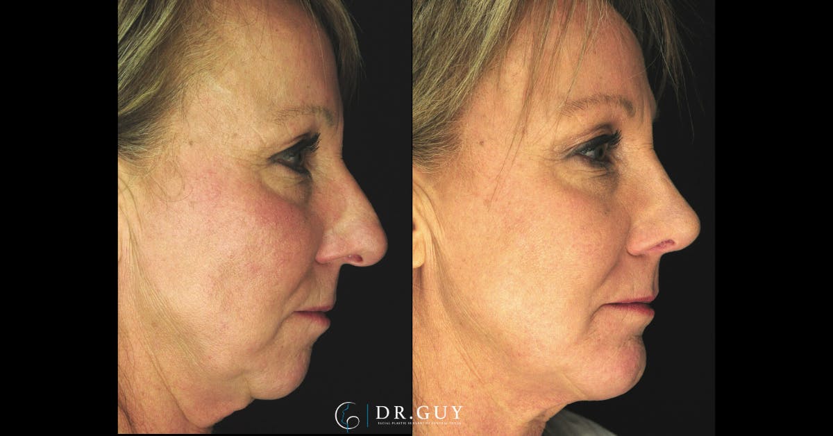 Chin Before & After Gallery - Patient 314905 - Image 5