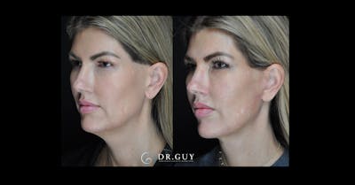 Mini Facelift Before & After Gallery - Patient 273881 - Image 1