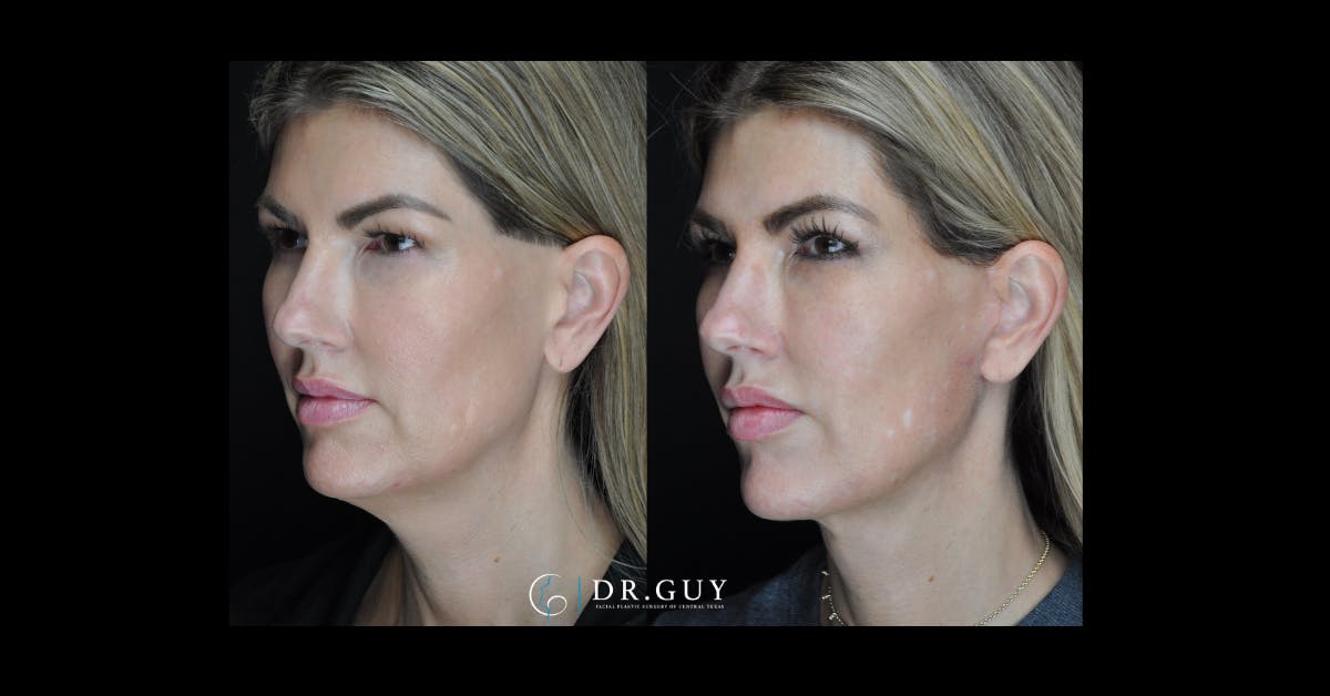 Mini Facelift Before & After Gallery - Patient 273881 - Image 1