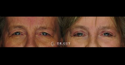 Browlift Before & After Gallery - Patient 320362 - Image 1
