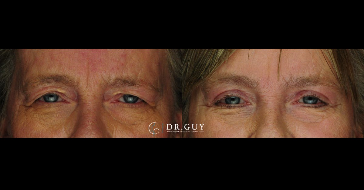 Browlift Before & After Gallery - Patient 320362 - Image 1