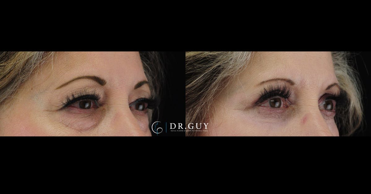 Lower Blepharoplasty Before & After Gallery - Patient 234744 - Image 2
