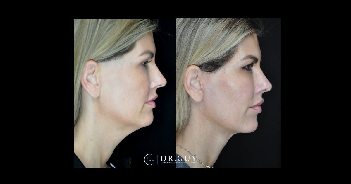Mini Facelift Before & After Gallery - Patient 273881 - Image 2