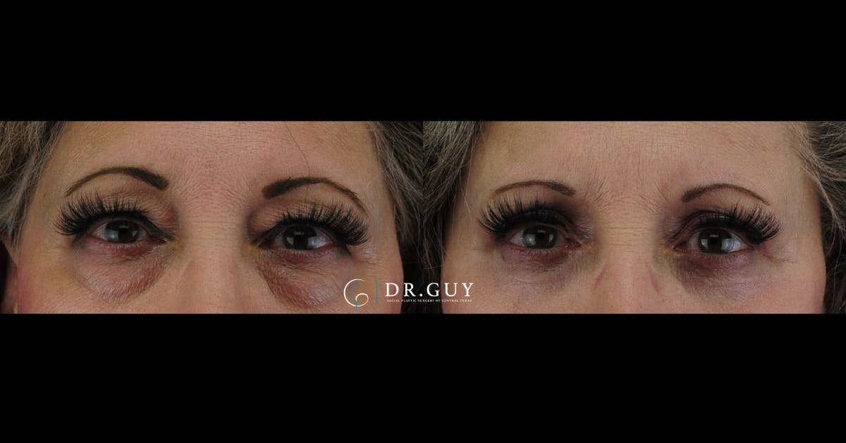 Lower Blepharoplasty Before & After Gallery - Patient 234744 - Image 3