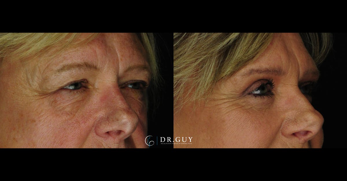 Upper Blepharoplasty Before & After Gallery - Patient 137071 - Image 4