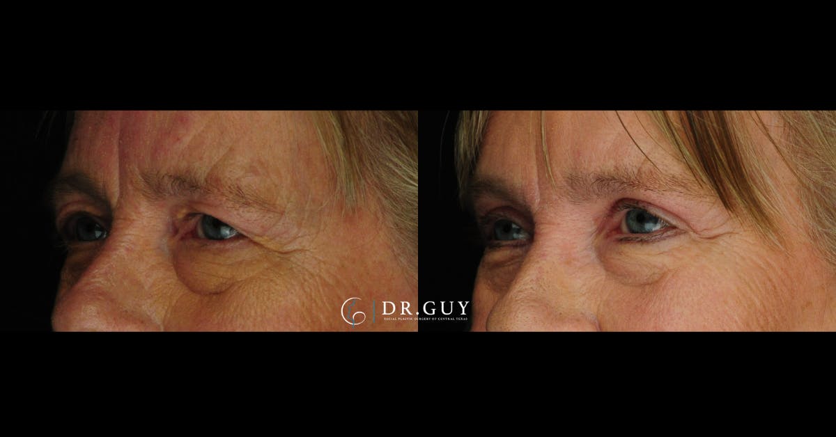 Browlift Before & After Gallery - Patient 320362 - Image 2