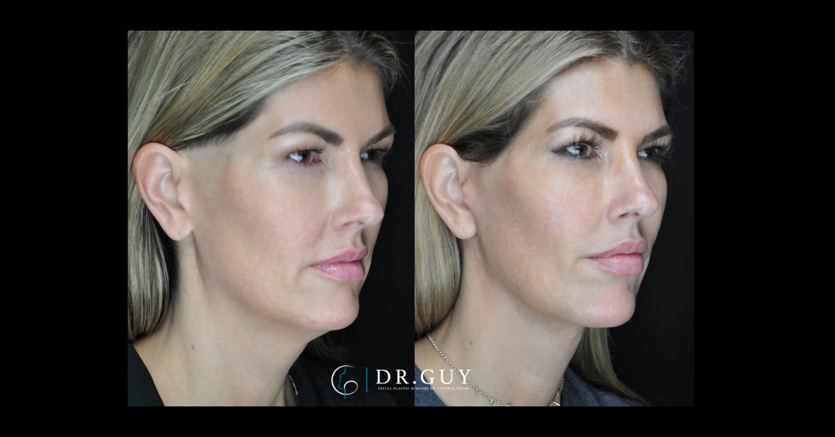 Mini Facelift Before & After Gallery - Patient 273881 - Image 3