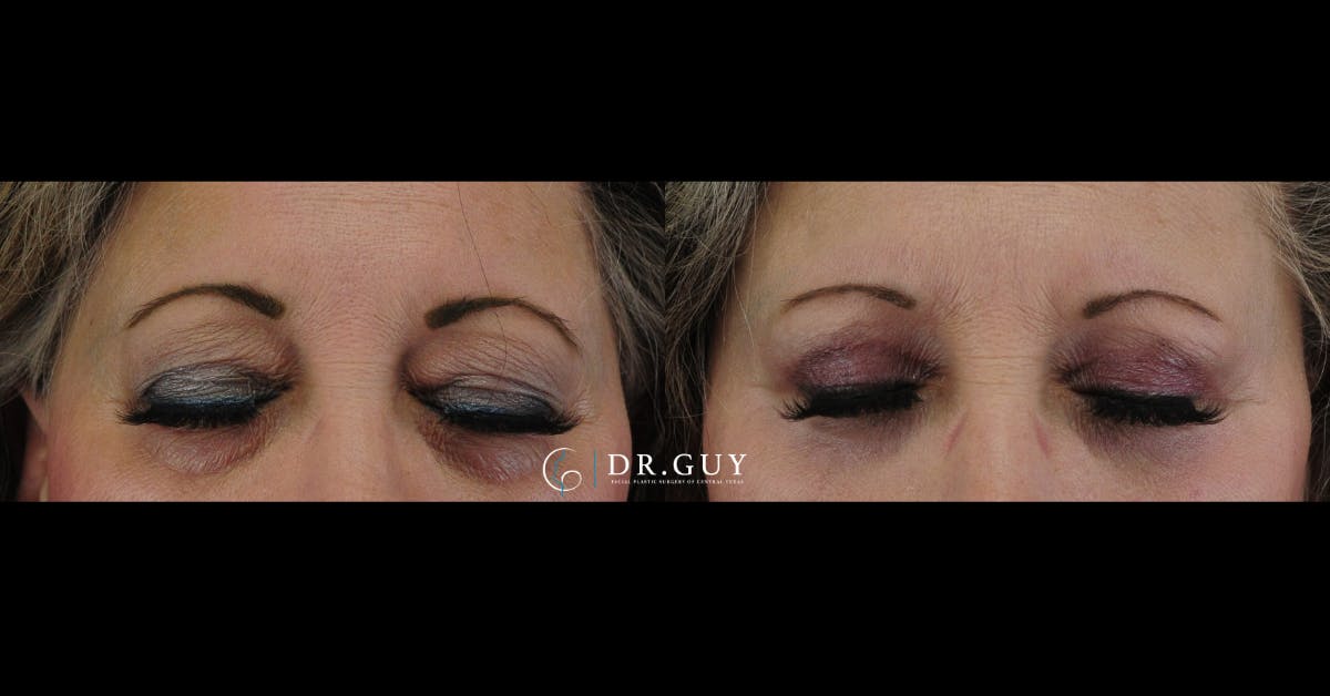 Lower Blepharoplasty Before & After Gallery - Patient 234744 - Image 4