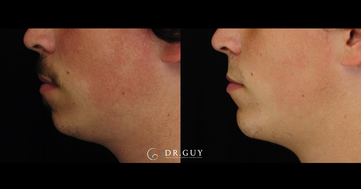 Chin Before & After Gallery - Patient 316487 - Image 1