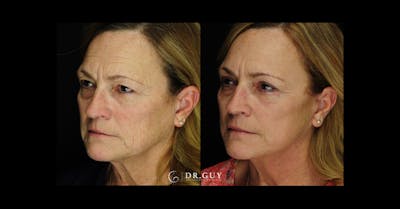 Mini Facelift Before & After Gallery - Patient 332576 - Image 1