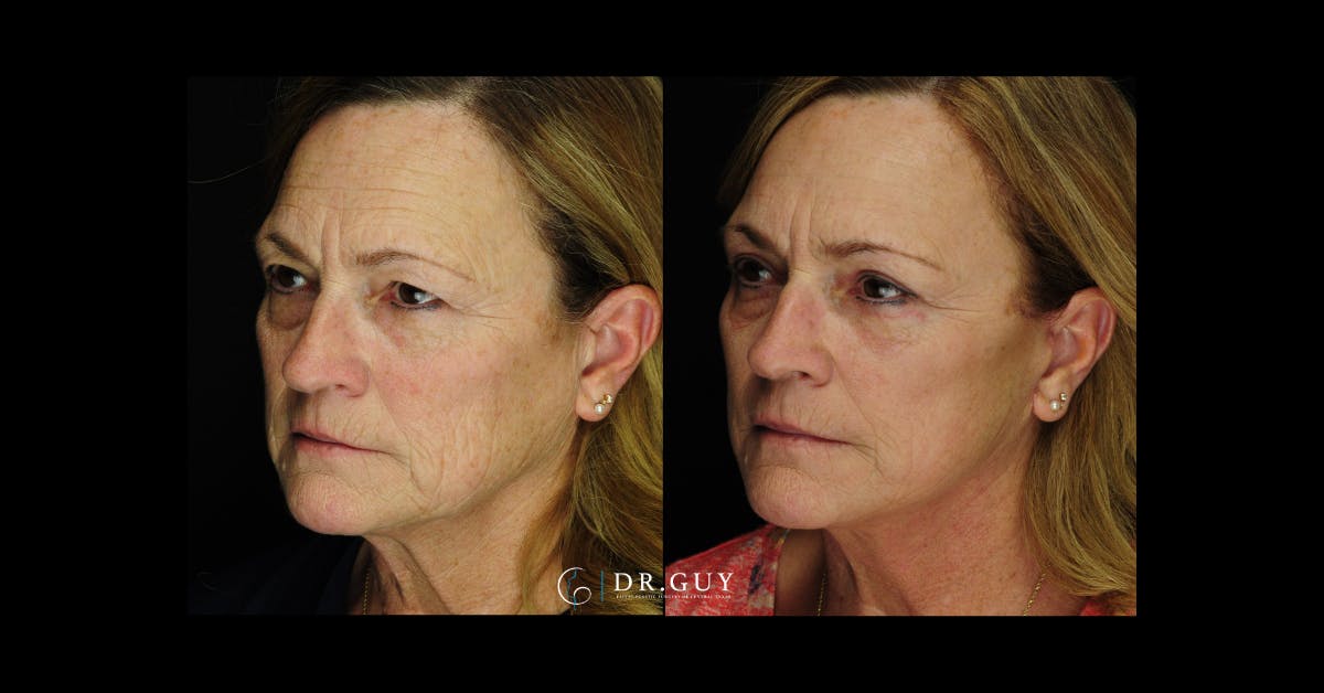 Mini Facelift Before & After Gallery - Patient 332576 - Image 1