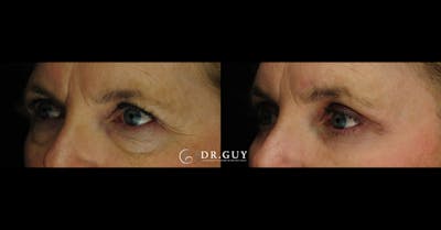Lower Blepharoplasty Before & After Gallery - Patient 414994 - Image 1