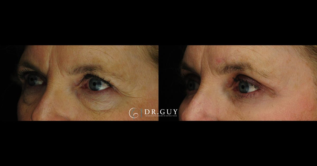 Lower Blepharoplasty Before & After Gallery - Patient 414994 - Image 1