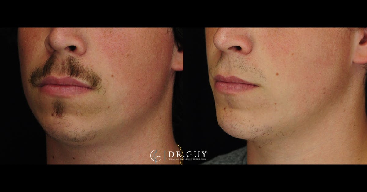Chin Before & After Gallery - Patient 316487 - Image 2