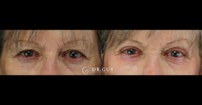 Upper Blepharoplasty Before & After Gallery - Patient 157607 - Image 1