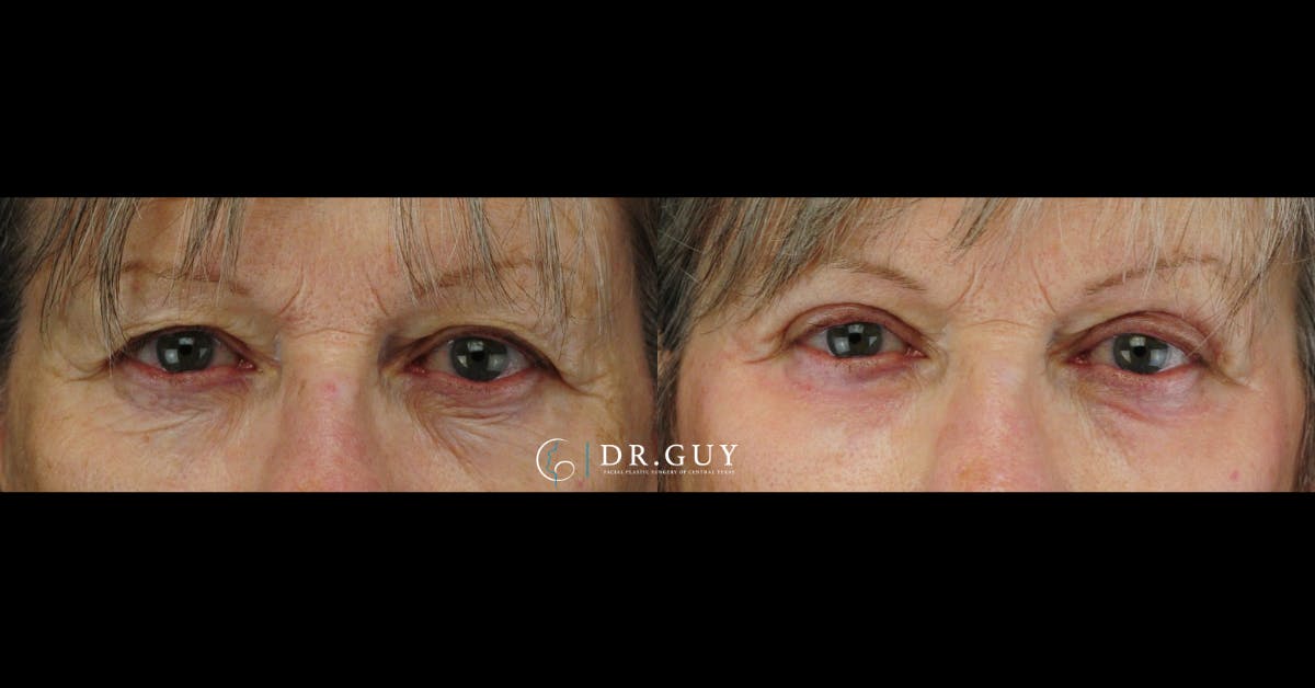 Upper Blepharoplasty Before & After Gallery - Patient 157607 - Image 1