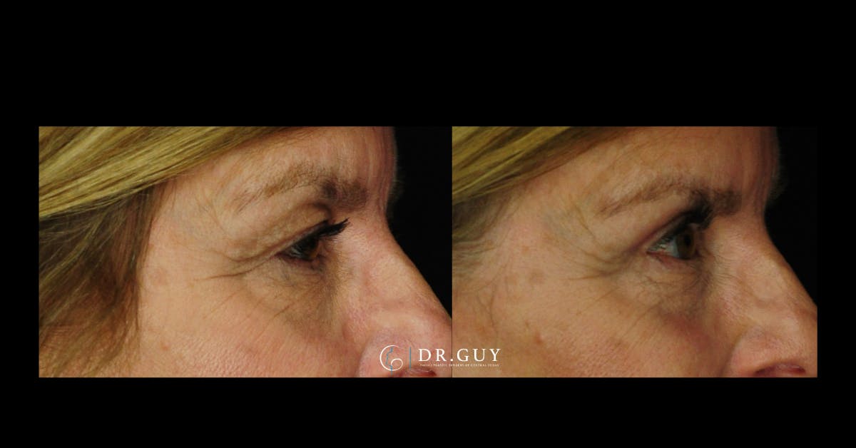 Browlift Before & After Gallery - Patient 559535 - Image 1