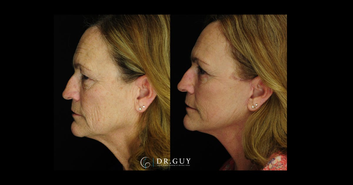 Mini Facelift Before & After Gallery - Patient 332576 - Image 2