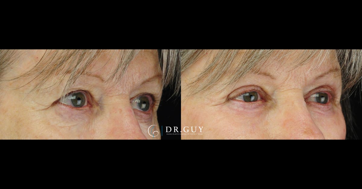 Upper Blepharoplasty Before & After Gallery - Patient 157607 - Image 2
