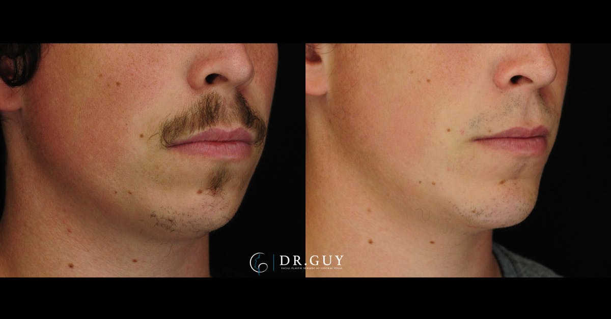Chin Before & After Gallery - Patient 316487 - Image 3