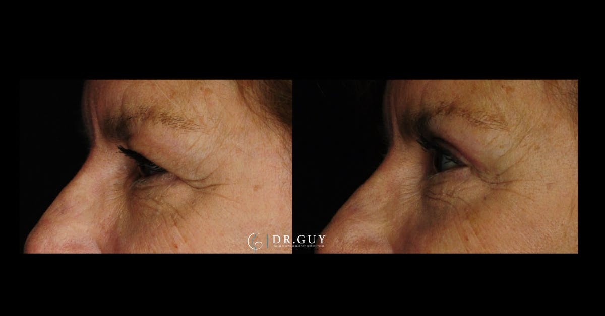 Browlift Before & After Gallery - Patient 559535 - Image 2
