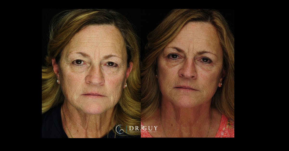 Mini Facelift Before & After Gallery - Patient 332576 - Image 3