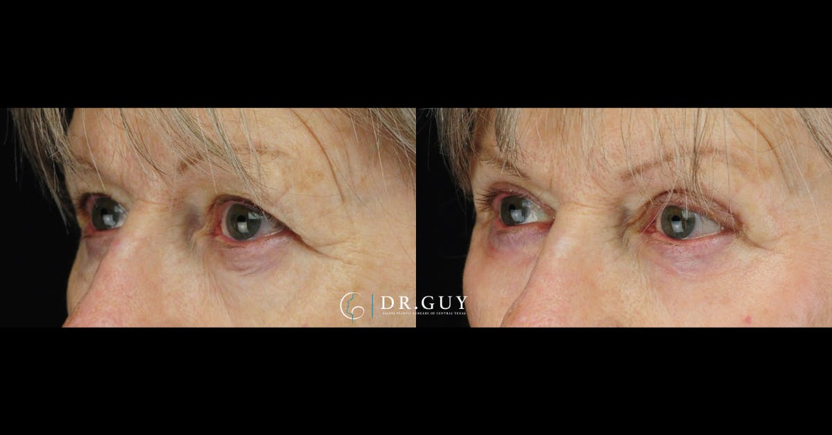 Upper Blepharoplasty Before & After Gallery - Patient 157607 - Image 3