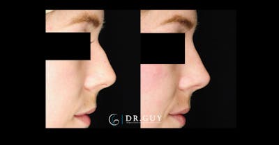 Liquid Rhinoplasty Before & After Gallery - Patient 272738 - Image 1