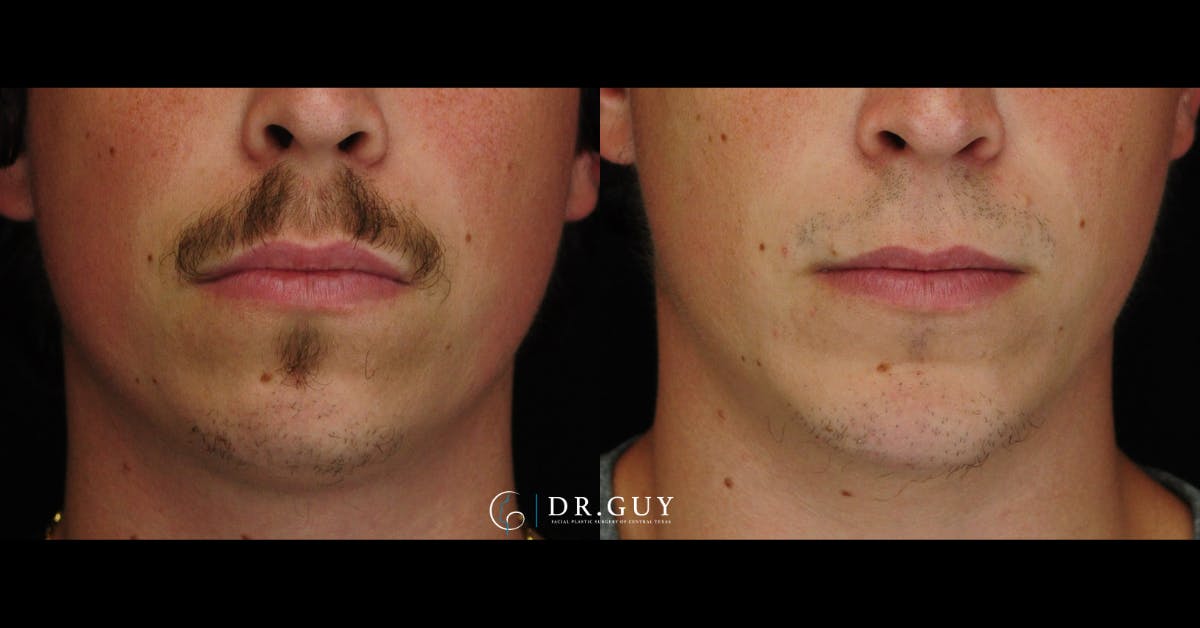 Chin Before & After Gallery - Patient 316487 - Image 4