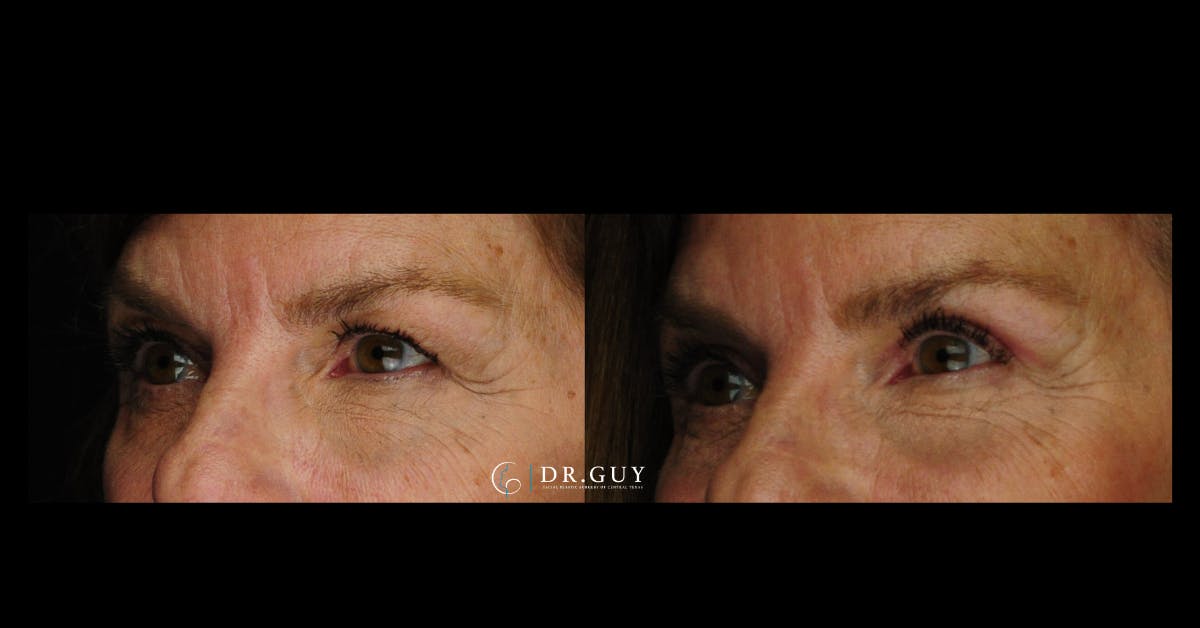 Browlift Before & After Gallery - Patient 559535 - Image 3