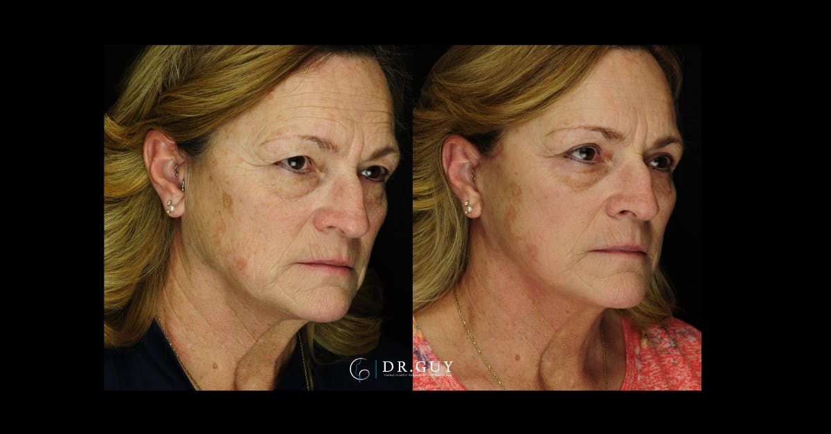 Mini Facelift Before & After Gallery - Patient 332576 - Image 4