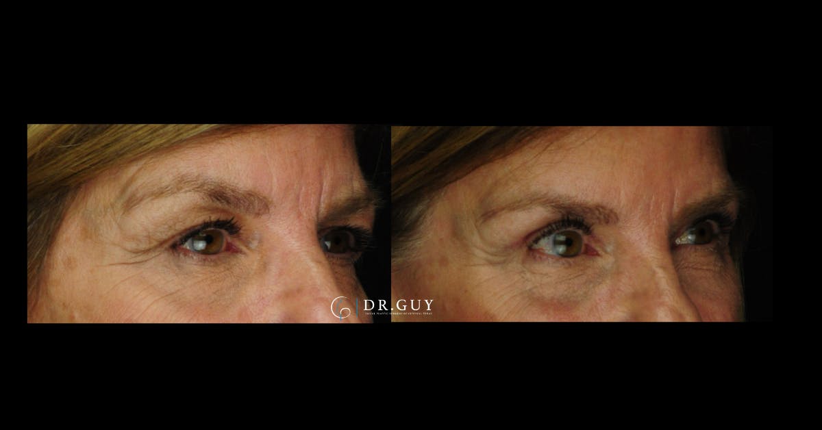 Browlift Before & After Gallery - Patient 559535 - Image 4