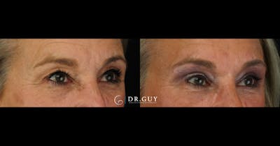 Upper Blepharoplasty Before & After Gallery - Patient 310236 - Image 1