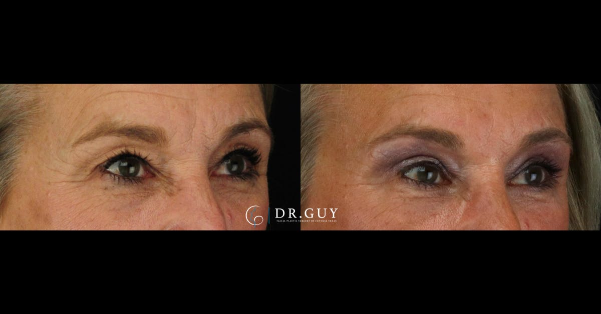 Upper Blepharoplasty Before & After Gallery - Patient 310236 - Image 1