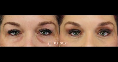 Lower Blepharoplasty Before & After Gallery - Patient 148084 - Image 1