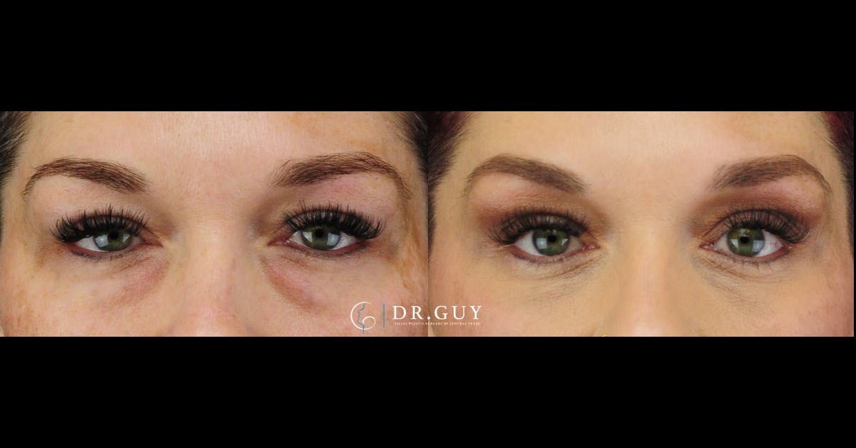 Lower Blepharoplasty Before & After Gallery - Patient 148084 - Image 1