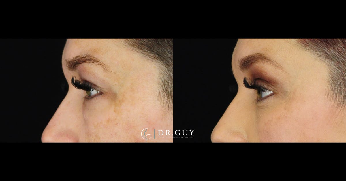 Lower Blepharoplasty Before & After Gallery - Patient 148084 - Image 2