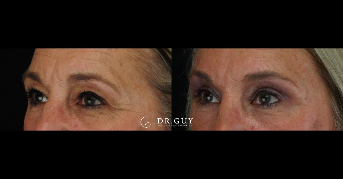 Upper Blepharoplasty Before & After Gallery - Patient 310236 - Image 2