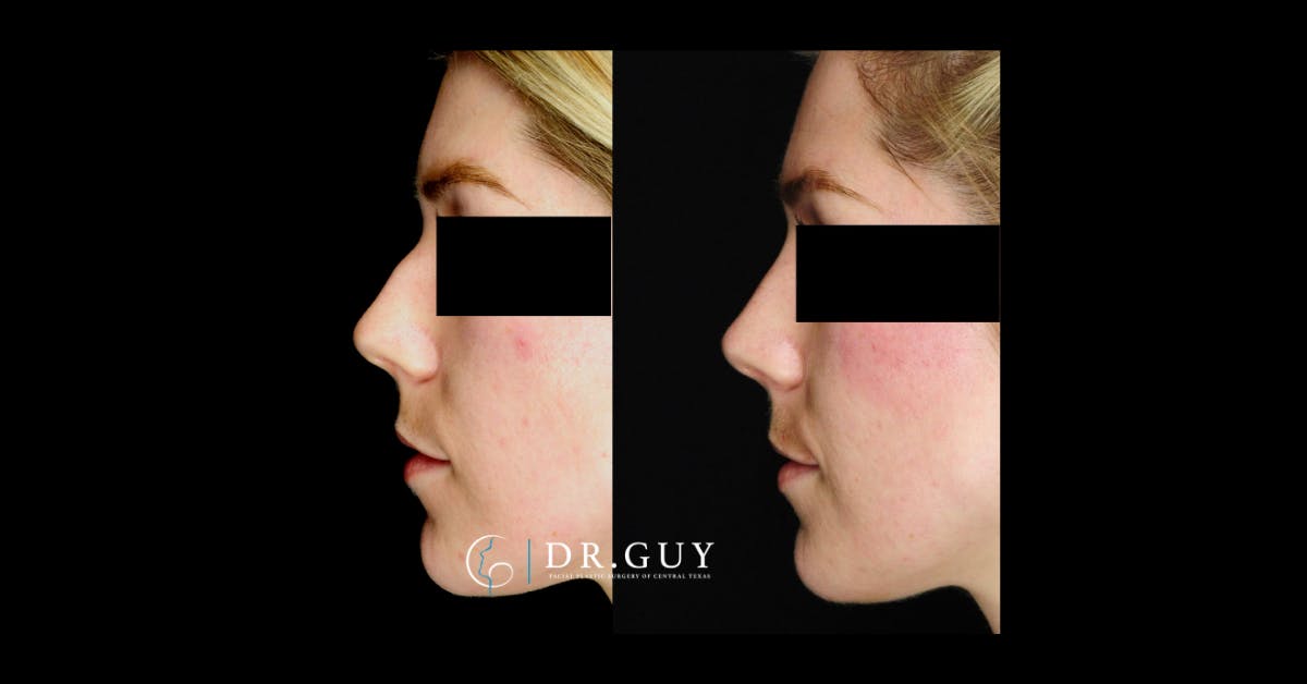 Liquid Rhinoplasty Before & After Gallery - Patient 272738 - Image 3