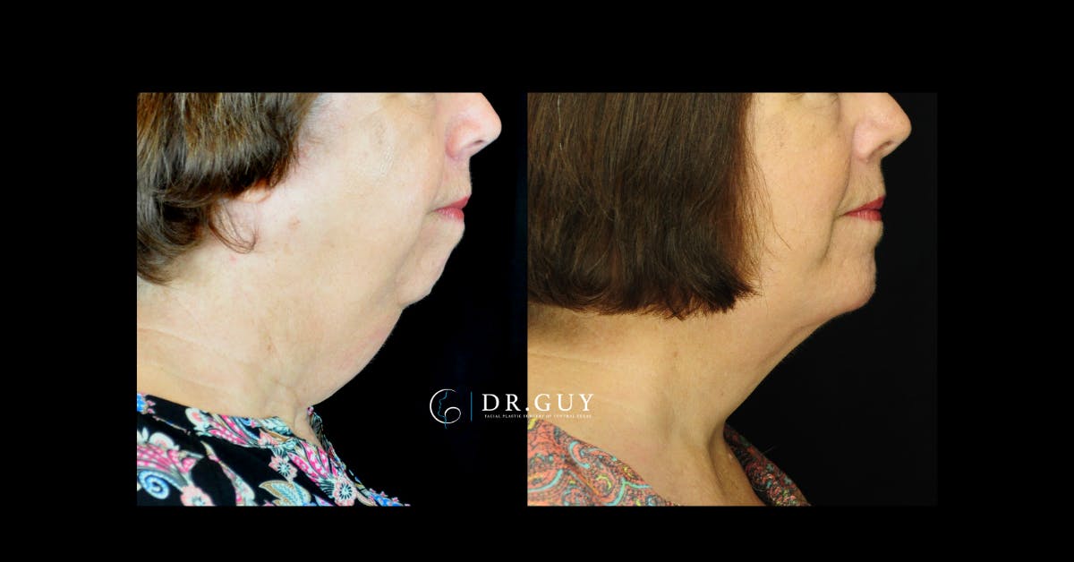 Chin Before & After Gallery - Patient 780384 - Image 2