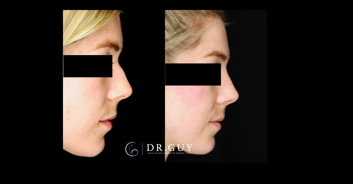 Liquid Rhinoplasty Before & After Gallery - Patient 272738 - Image 4