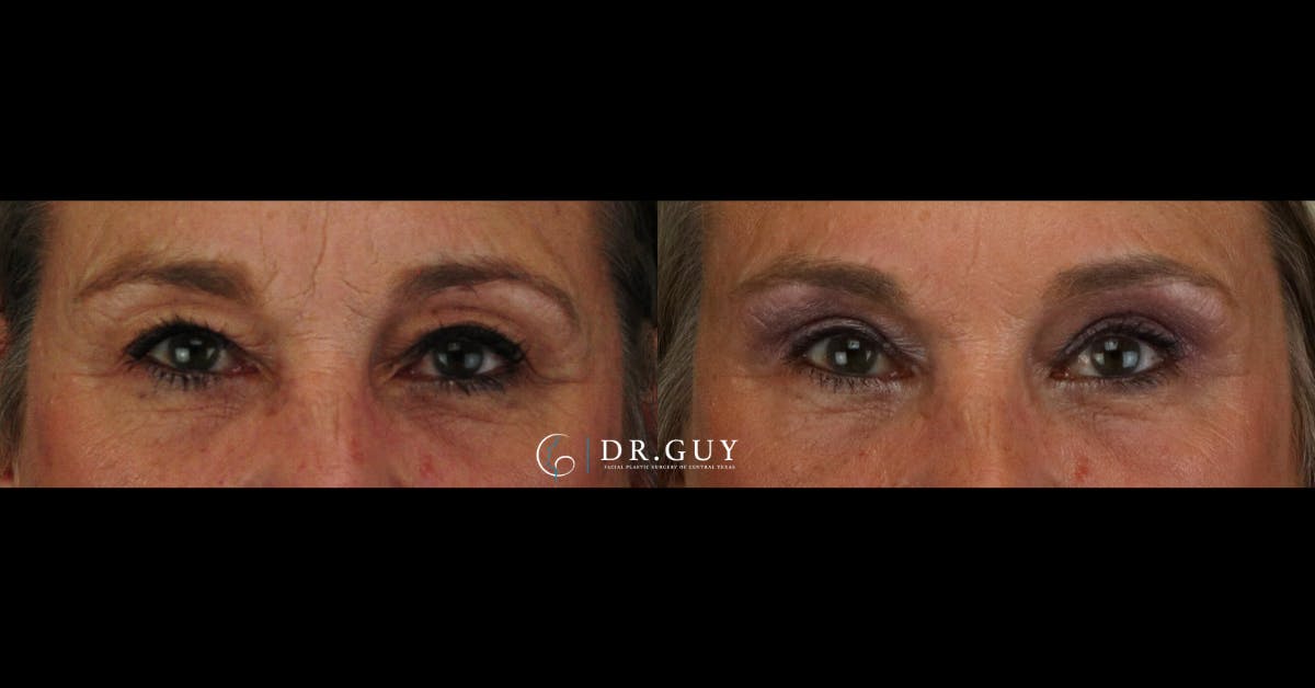 Upper Blepharoplasty Before & After Gallery - Patient 310236 - Image 3