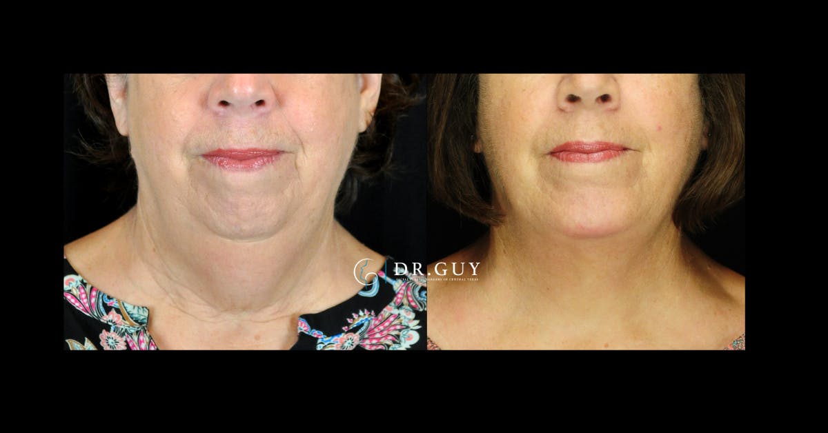 Chin Before & After Gallery - Patient 780384 - Image 3