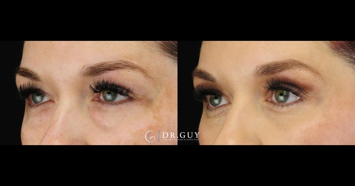 Lower Blepharoplasty Before & After Gallery - Patient 148084 - Image 3